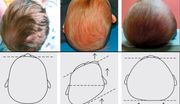 flat head syndrome