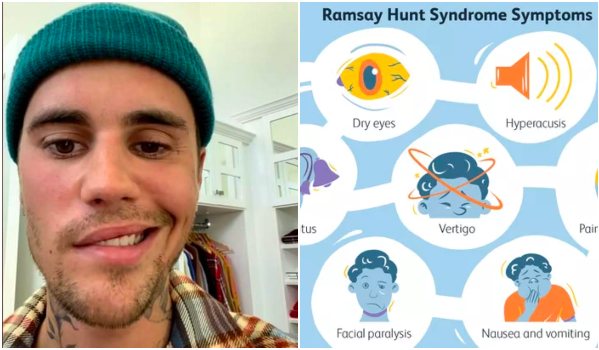 ramsay hunt