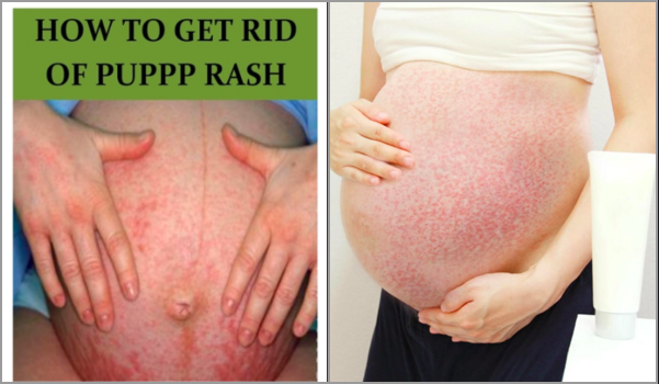 gatal perut semasa mengandung
