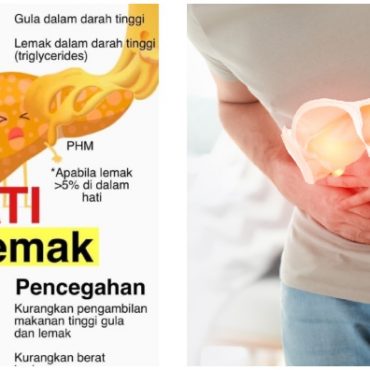 simptom hati berlemak