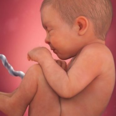 bayi terbelit tali pusat