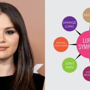 apa itu penyakit lupus
