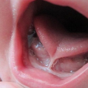 tanda-tanda tongue tie
