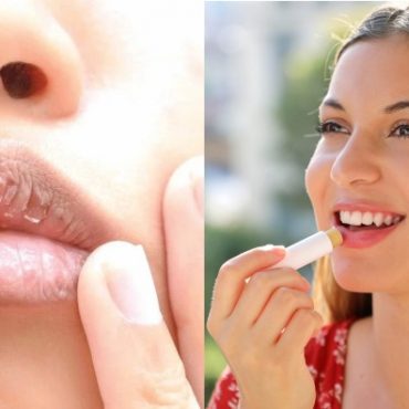 bibir menggelupas