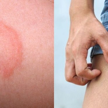 tips atasi gatal celah paha