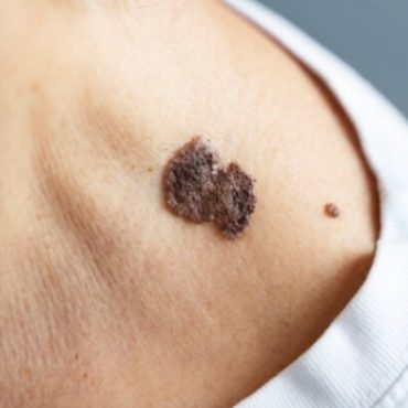 apa itu skin tags