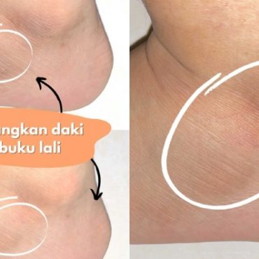 buku lali berdaki