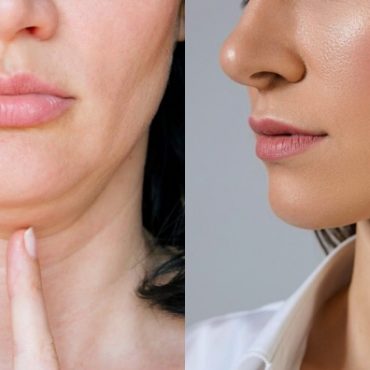 cara hilangkan double chin
