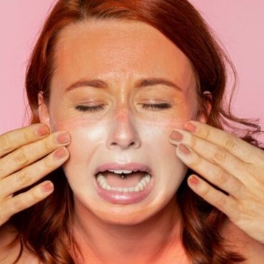 cara hilangkan sunburn muka