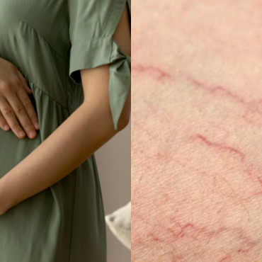 SPIDER VEINS PADA PAYUDARA