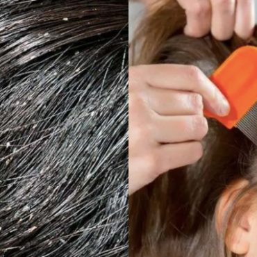 cara hilangkan kutu rambut