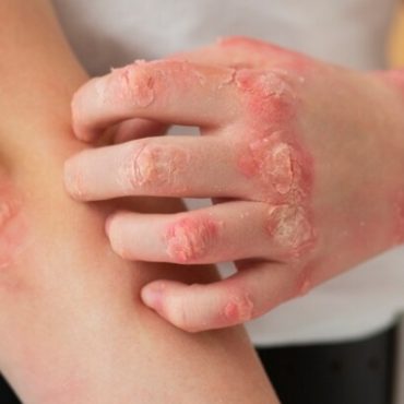 penyakit psoriasis