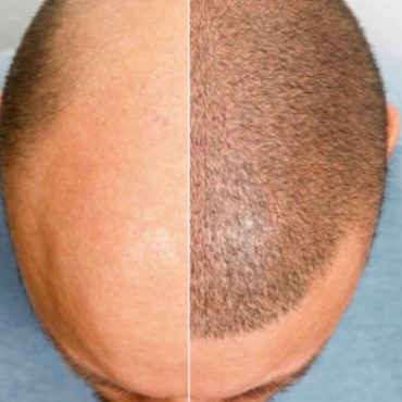 hukum tanam rambut