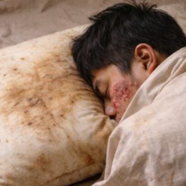 Sarung Bantal Kotor Boleh Jadi Punca Pori Muka Tersumbat & Berjerawat