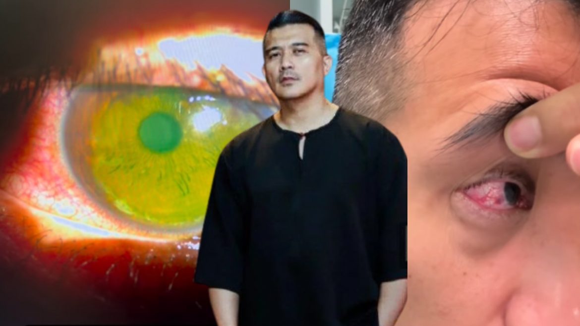 [VIDEO] Aaron Aziz Alami Kecederaan Mata, Dipercayai Terkena Bola Pickleball